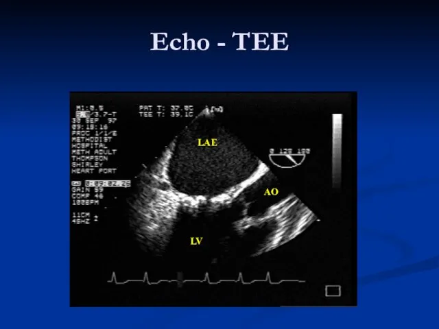 LAE LV AO Echo - TEE