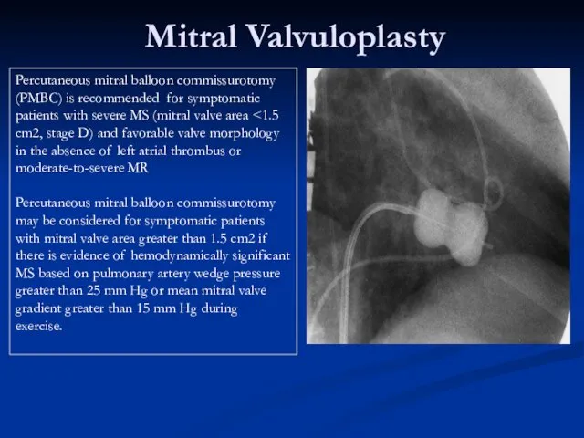 Mitral Valvuloplasty Percutaneous mitral balloon commissurotomy (PMBC) is recommended for