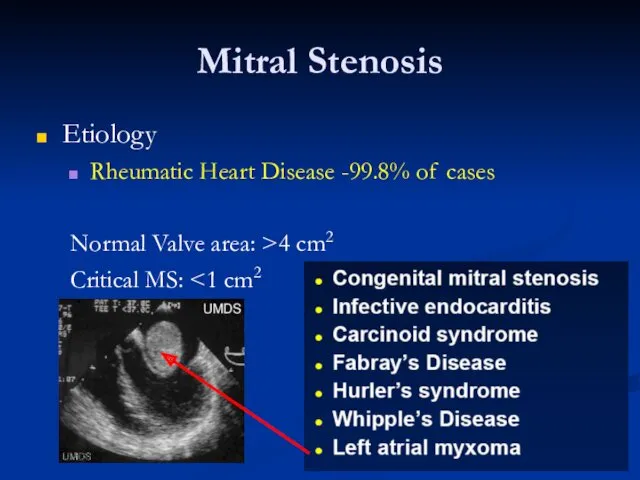 Mitral Stenosis Etiology Rheumatic Heart Disease -99.8% of cases Normal Valve area: >4 cm2 Critical MS:
