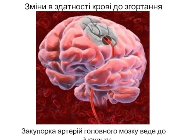 Зміни в здатності крові до згортання Закупорка артерій головного мозку веде до інсульту