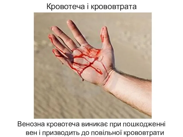 Кровотеча і крововтрата Венозна кровотеча виникає при пошкодженні вен і призводить до повільної крововтрати