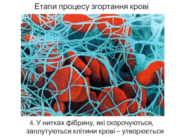 Етапи процесу згортання крові 4. У нитках фібрину, які скорочуються, заплутуються клітини крові – утворюється тромб