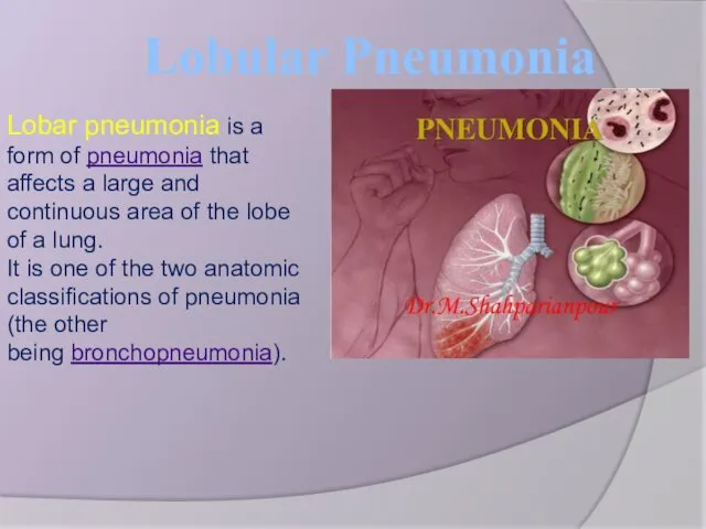 Lobular Pneumonia Lobar pneumonia is a form of pneumonia that