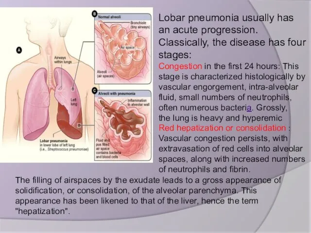 Lobar pneumonia usually has an acute progression. Classically, the disease