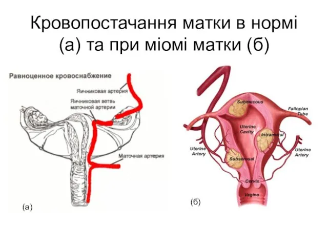 Кровопостачання матки в нормі (а) та при міомі матки (б) (а) (б)