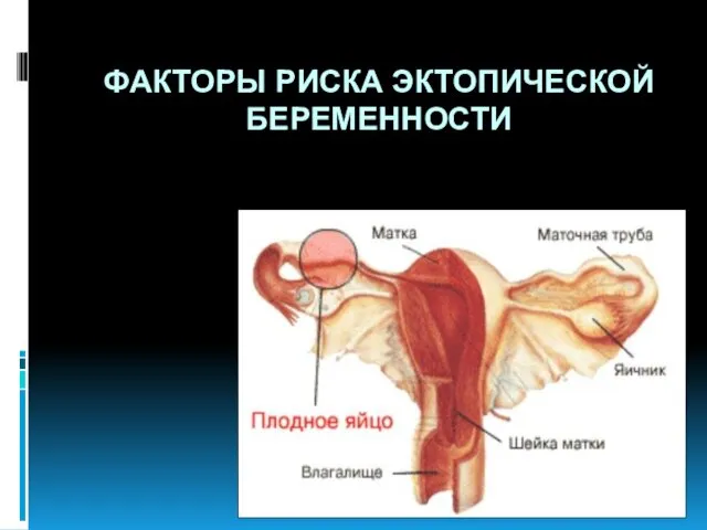 ФАКТОРЫ РИСКА ЭКТОПИЧЕСКОЙ БЕРЕМЕННОСТИ