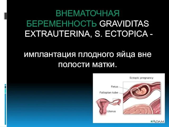 ВНЕМАТОЧНАЯ БЕРЕМЕННОСТЬ GRAVIDITAS EXTRAUTERINA, S. ECTOPICA - имплантация плодного яйца вне полости матки.