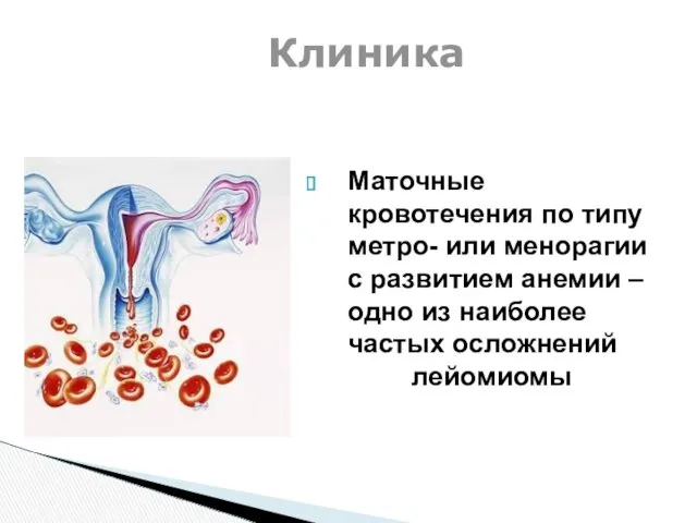 Маточные кровотечения по типу метро- или менорагии с развитием анемии