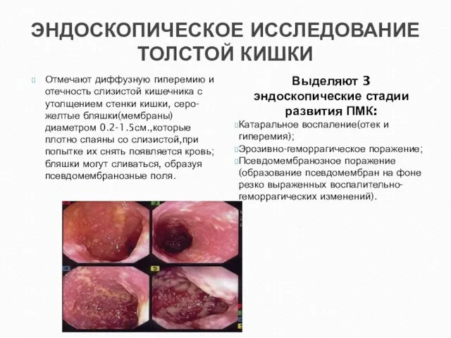 ЭНДОСКОПИЧЕСКОЕ ИССЛЕДОВАНИЕ ТОЛСТОЙ КИШКИ Отмечают диффузную гиперемию и отечность слизистой кишечника с утолщением