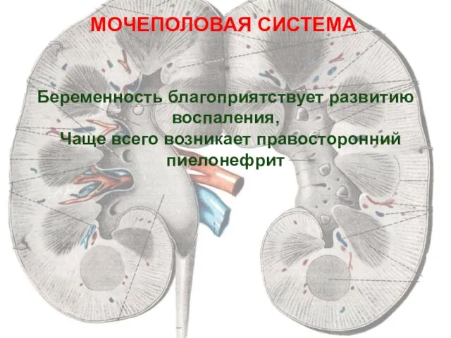 МОЧЕПОЛОВАЯ СИСТЕМА Беременность благоприятствует развитию воспаления, Чаще всего возникает правосторонний пиелонефрит