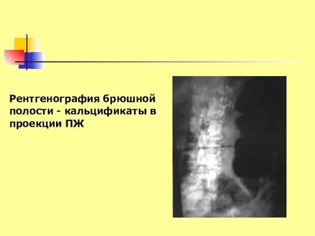 Рентгенография брюшной полости - кальцификаты в проекции ПЖ