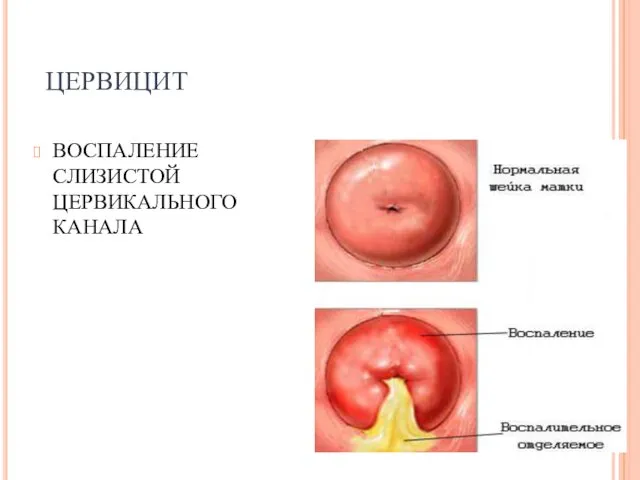 ЦЕРВИЦИТ ВОСПАЛЕНИЕ СЛИЗИСТОЙ ЦЕРВИКАЛЬНОГО КАНАЛА