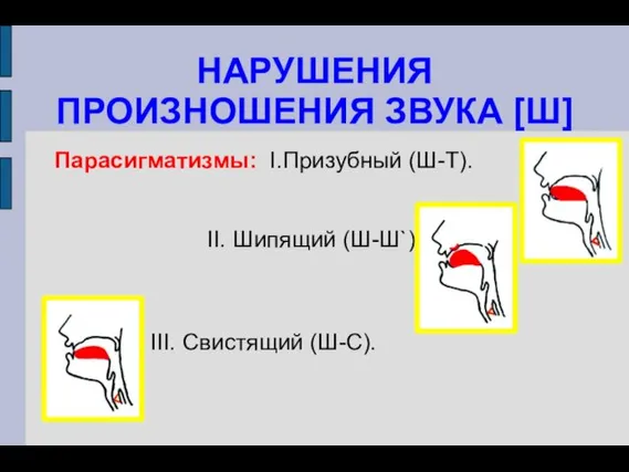 НАРУШЕНИЯ ПРОИЗНОШЕНИЯ ЗВУКА [Ш] Парасигматизмы: I.Призубный (Ш-Т). II. Шипящий (Ш-Ш`). III. Свистящий (Ш-С).