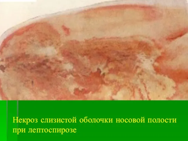 Некроз слизистой оболочки носовой полости при лептоспирозе