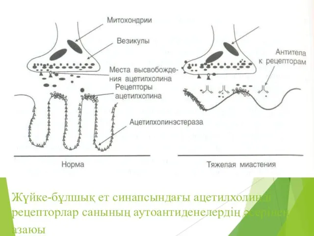 Жүйке-бұлшық ет синапсындағы ацетилхолинді рецепторлар санының аутоантиденелердің әсерінен азаюы