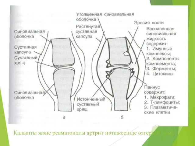 Қалыпты және ревматоидты артрит нәтижесінде өзгерген буын