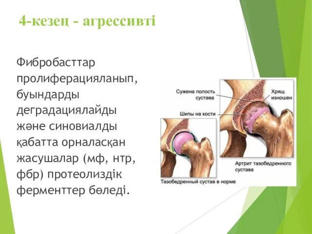 4-кезең - агрессивті Фибробасттар пролиферацияланып, буындарды деградациялайды және синовиалды қабатта