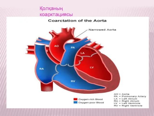 Қолқаның коарктациясы