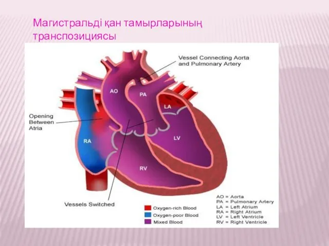 Магистральді қан тамырларының транспозициясы