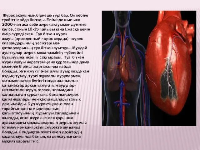 Жүрек ақауының бірнеше түрі бар. Ол көбіне туабітті пайда болады.