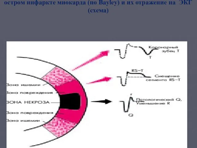 Три зоны патологических изменений в сердечной мышце при остром инфаркте миокарда (по Bayley)