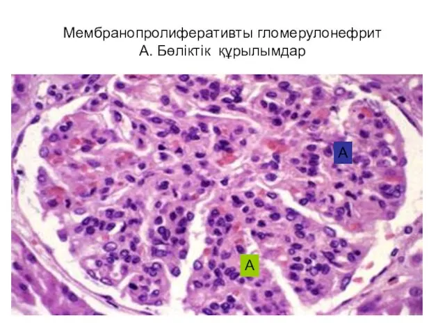 Мембранопролиферативты гломерулонефрит А. Бөліктік құрылымдар А А