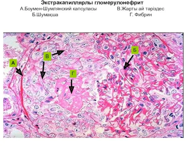 Экстракапиллярлы гломерулонефрит А.Боумен-Шумлянский капсуласы В.Жарты ай тәріздес Б.Шумақша Г. Фибрин А В Г Б