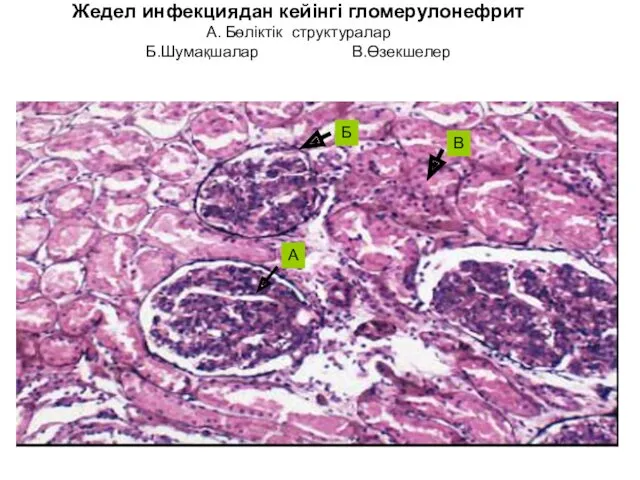 Жедел инфекциядан кейінгі гломерулонефрит А. Бөліктік структуралар Б.Шумақшалар В.Өзекшелер А Б В