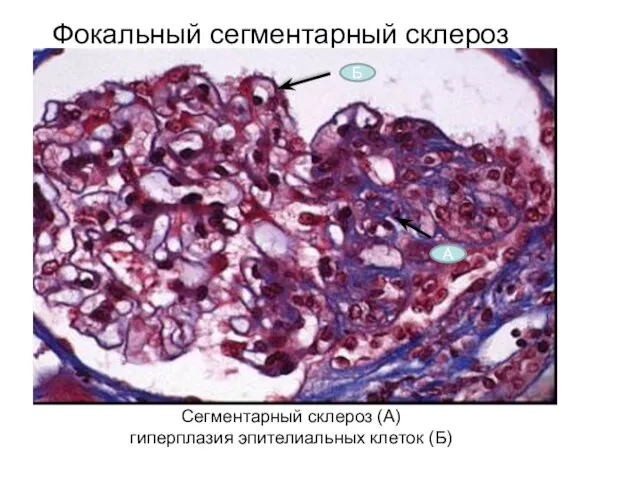Сегментарный склероз (А) гиперплазия эпителиальных клеток (Б) Фокальный сегментарный склероз А Б