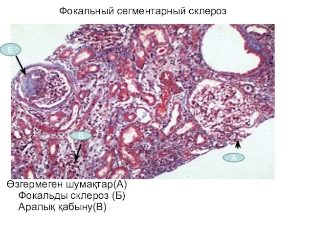 Фокальный сегментарный склероз Өзгермеген шумақтар(А) Фокальды склероз (Б) Аралық қабыну(В) А Б В
