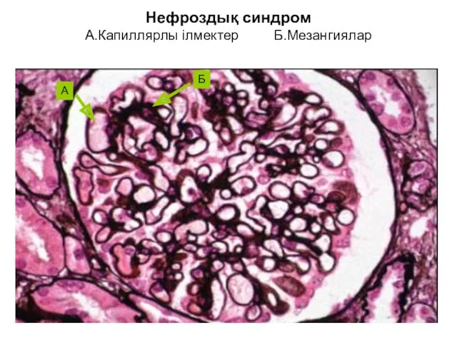 Нефроздық синдром А.Капиллярлы ілмектер Б.Мезангиялар А Б