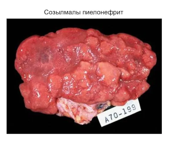 Созылмалы пиелонефрит