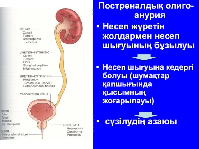 Постреналдық олиго-анурия Несеп жүретін жолдармен несеп шығуының бұзылуы Несеп шығуына