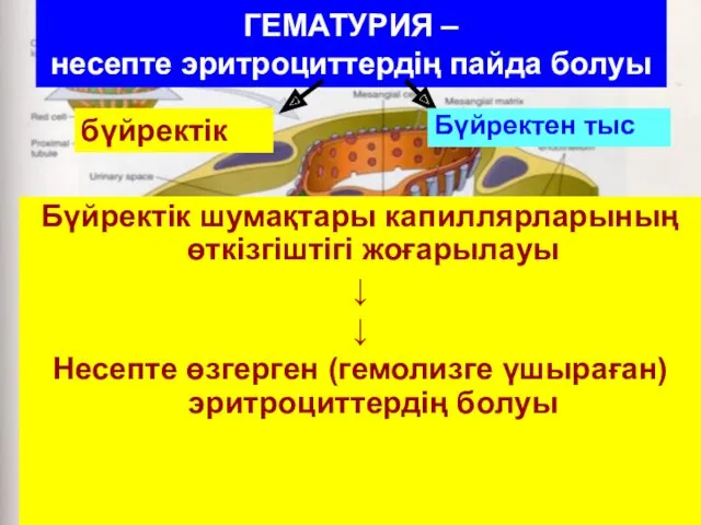 ГЕМАТУРИЯ – несепте эритроциттердің пайда болуы Бүйректік шумақтары капиллярларының өткізгіштігі