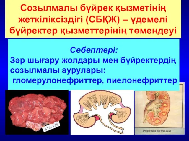 Созылмалы бүйрек қызметінің жеткіліксіздігі (СБҚЖ) – үдемелі бүйректер қызметтерінің төмендеуі