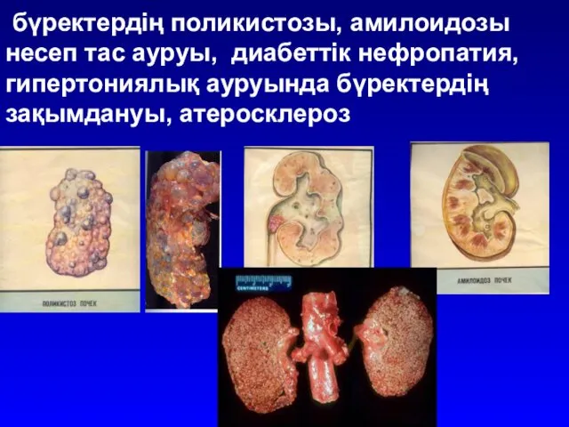 бүректердің поликистозы, амилоидозы несеп тас ауруы, диабеттік нефропатия, гипертониялық ауруында бүректердің зақымдануы, атеросклероз