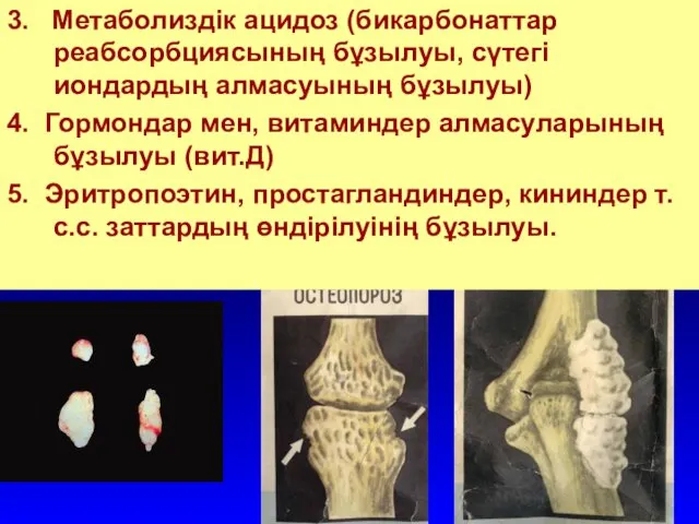 3. Метаболиздік ацидоз (бикарбонаттар реабсорбциясының бұзылуы, сүтегі иондардың алмасуының бұзылуы)