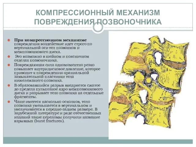 КОМПРЕССИОННЫЙ МЕХАНИЗМ ПОВРЕЖДЕНИЯ ПОЗВОНОЧНИКА При компрессионном механизме повреждения воздействие идет