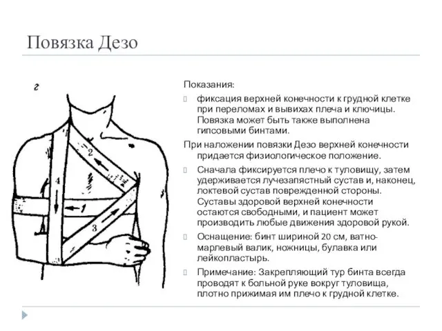 Повязка Дезо Показания: фиксация верхней конечности к грудной клетке при