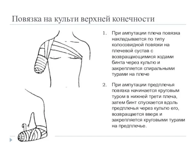Повязка на культи верхней конечности При ампутации плеча повязка накладывается