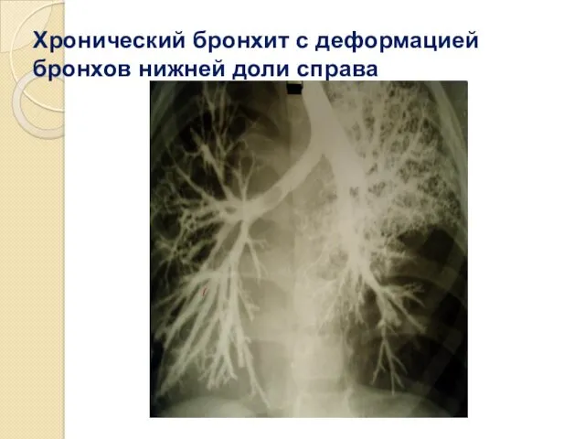 Хронический бронхит с деформацией бронхов нижней доли справа