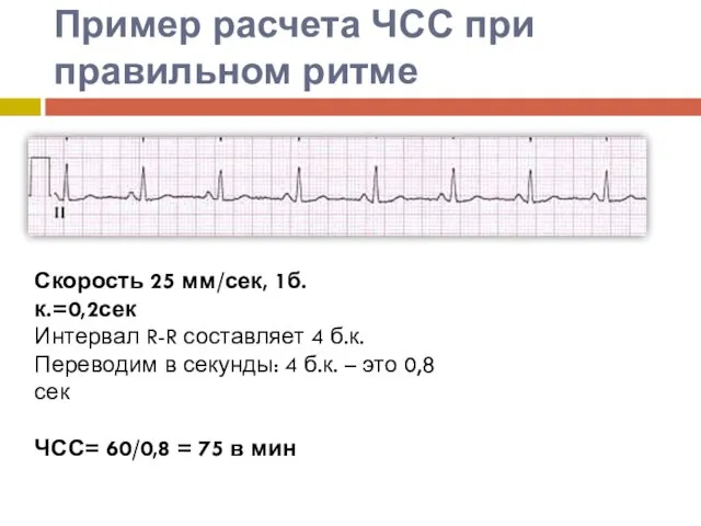 Пример расчета ЧСС при правильном ритме Скорость 25 мм/сек, 1б.к.=0,2сек