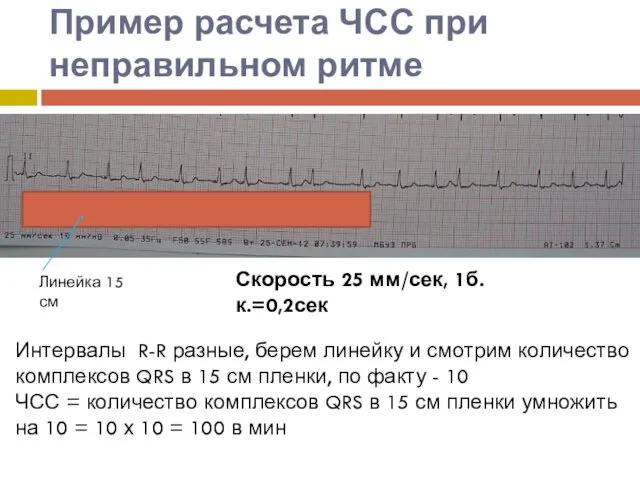 Пример расчета ЧСС при неправильном ритме Скорость 25 мм/сек, 1б.к.=0,2сек