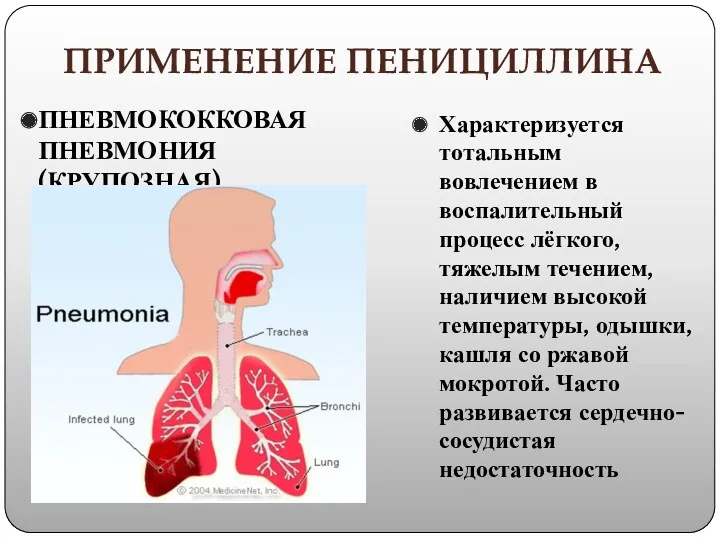 ПРИМЕНЕНИЕ ПЕНИЦИЛЛИНА ПНЕВМОКОККОВАЯ ПНЕВМОНИЯ (КРУПОЗНАЯ) Характеризуется тотальным вовлечением в воспалительный