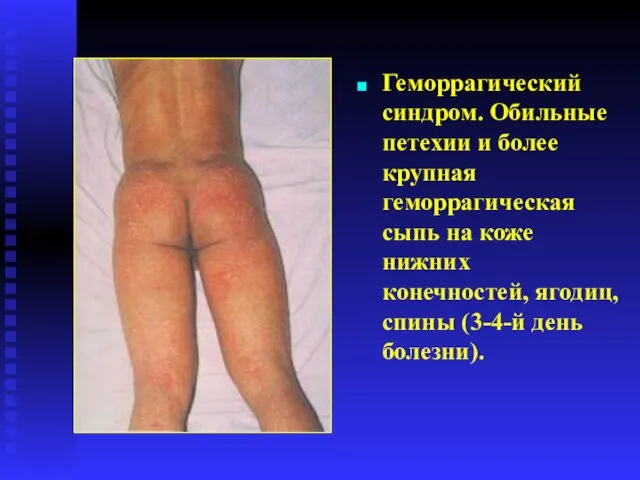 Геморрагический синдром. Обильные петехии и более крупная геморрагическая сыпь на коже нижних конечностей,