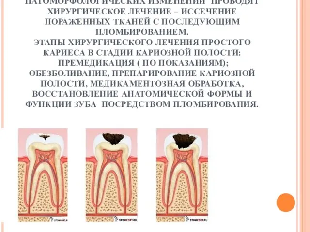 ПРИ ПРОСТОМ КАРИЕСЕ В СТАДИИ КАРИОЗНОЙ ПОЛОСТИ ПРИ НЕОБРАТИМОМ ХАРАКТЕРЕ