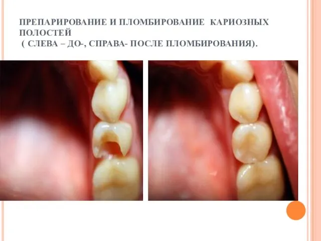 ПРЕПАРИРОВАНИЕ И ПЛОМБИРОВАНИЕ КАРИОЗНЫХ ПОЛОСТЕЙ ( СЛЕВА – ДО-, СПРАВА- ПОСЛЕ ПЛОМБИРОВАНИЯ).