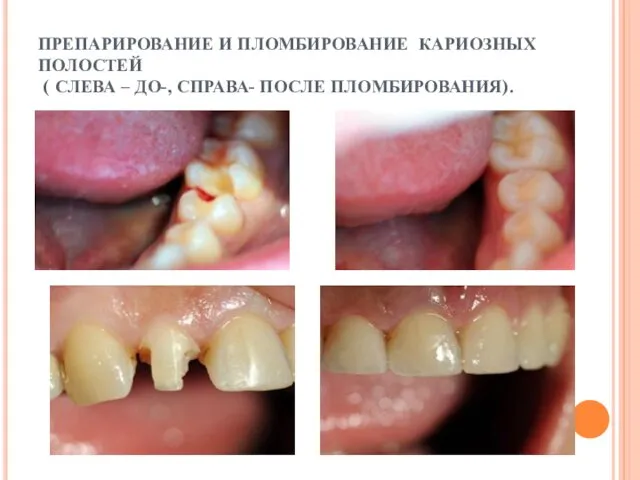 ПРЕПАРИРОВАНИЕ И ПЛОМБИРОВАНИЕ КАРИОЗНЫХ ПОЛОСТЕЙ ( СЛЕВА – ДО-, СПРАВА- ПОСЛЕ ПЛОМБИРОВАНИЯ).