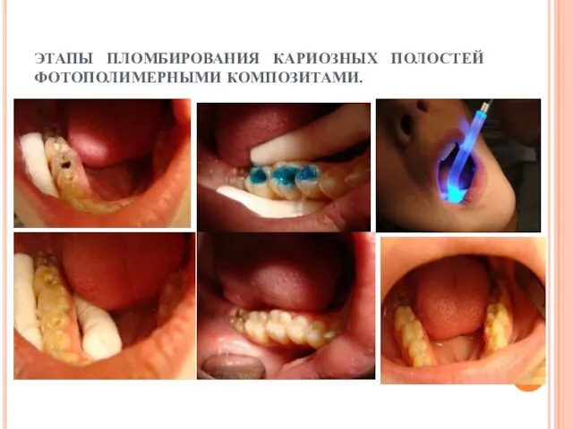 ЭТАПЫ ПЛОМБИРОВАНИЯ КАРИОЗНЫХ ПОЛОСТЕЙ ФОТОПОЛИМЕРНЫМИ КОМПОЗИТАМИ.