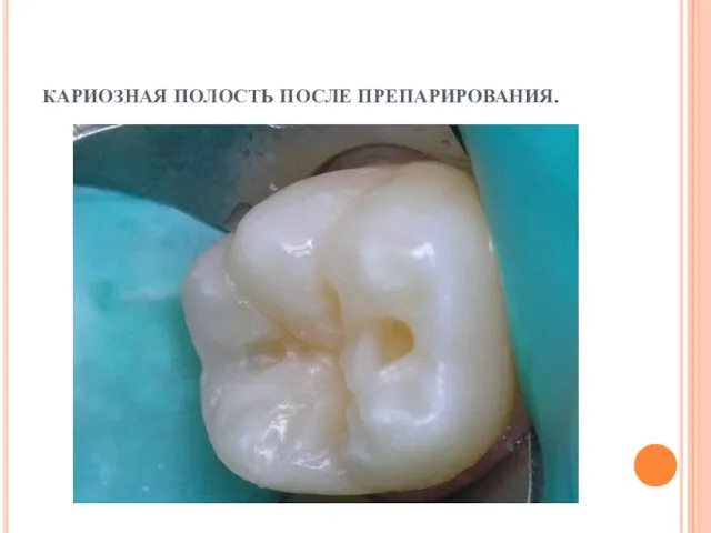 КАРИОЗНАЯ ПОЛОСТЬ ПОСЛЕ ПРЕПАРИРОВАНИЯ.